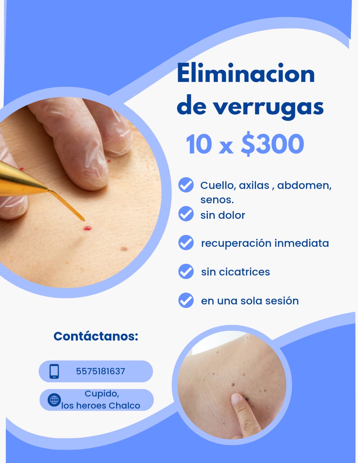 Eliminación de verrugas